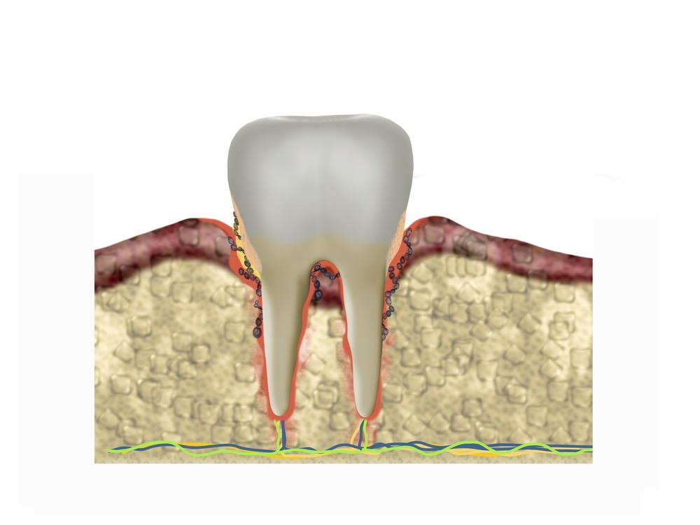 what are periodontal pockets