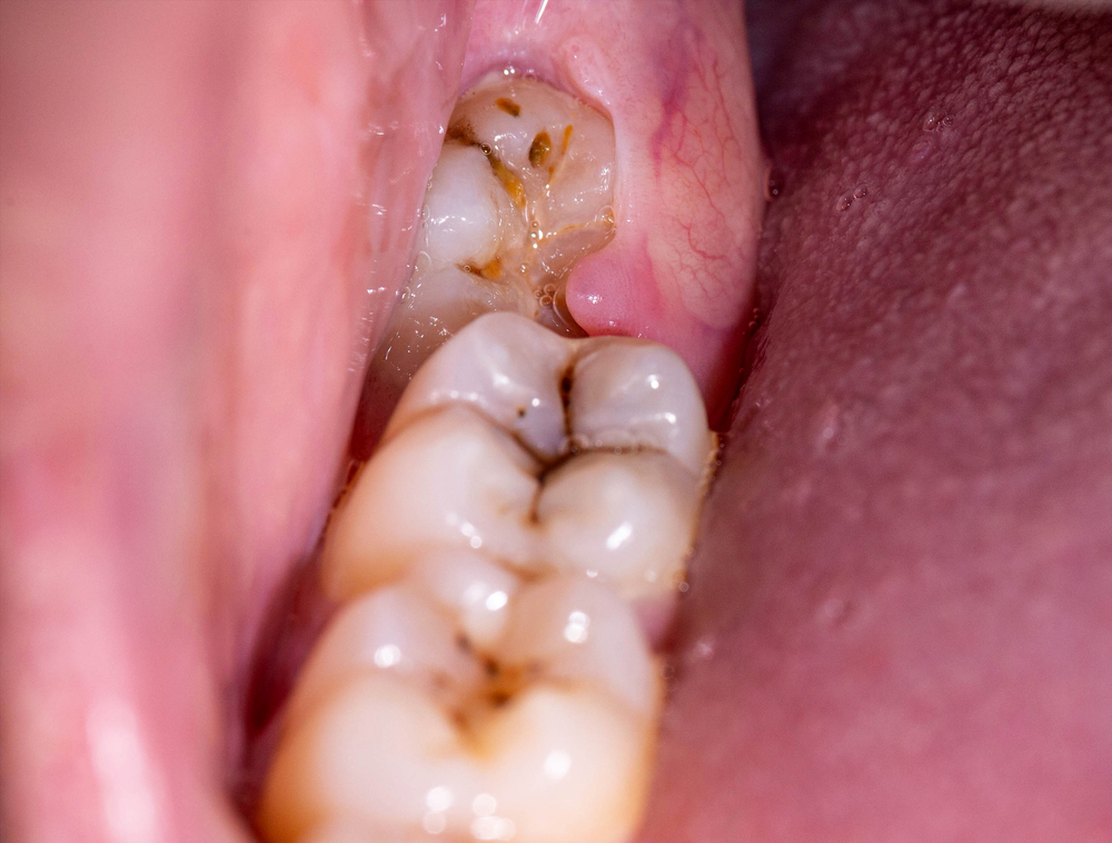 what pericoronitis looks like