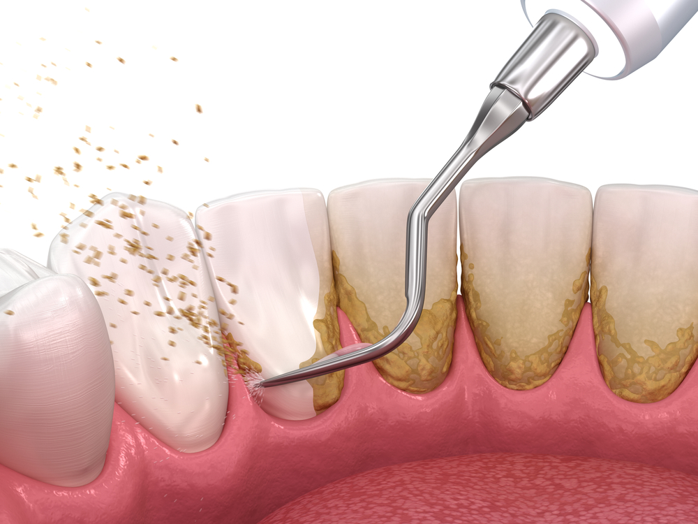 Difference Between Plaque and Tartar