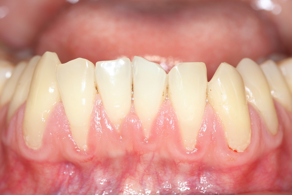 what receding gums look like