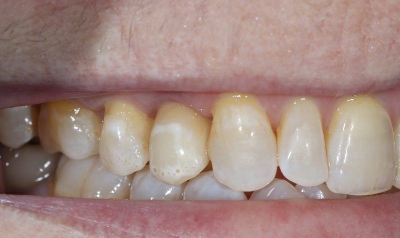 find the dental implant find the dental implant