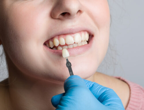 Pros and Cons of Dental Veneers