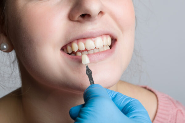 Pros and Cons of Dental Veneers Pros and Cons of Dental Veneers
