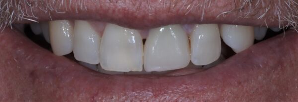 Veneer Dental Replacement for the Front Upper Teeth