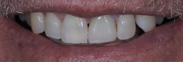 Veneer Dental Replacement for the Front Upper Teeth after Veneer Dental Replacement for the Front Upper Teeth