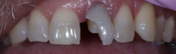 Veneer Dental Replacement for the Front Upper Teeth before Veneer Dental Replacement for the Front Upper Teeth