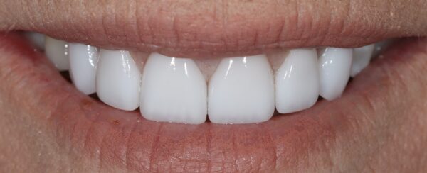 Why Do I Need Veneers Why Do I Need Veneers