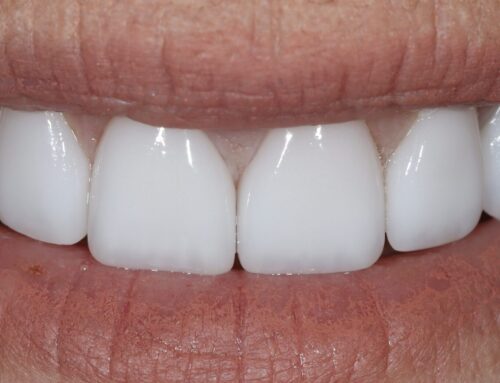 Veneer Replacement for a Brighter, Healthier Smile