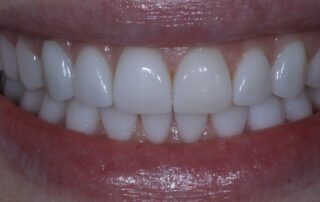 am i a good candidate for veneers keller tx