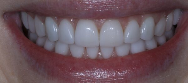 am i a good candidate for veneers keller tx