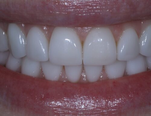 Am I A Good Fit For Veneers?