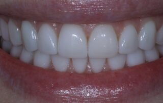 full mouth dental veneers