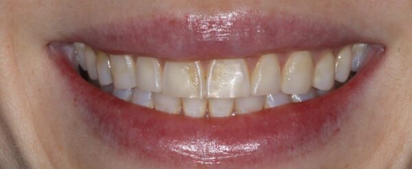 full mouth dental veneers
