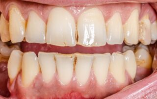 Causes of Stains on Teeth