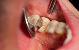 Everything You Need To Know About Dental Fillings