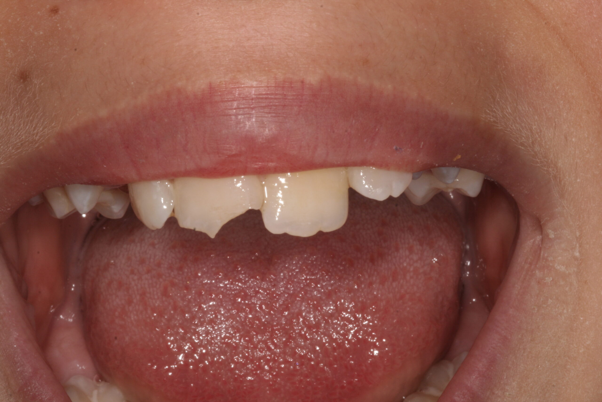 child with broken tooth