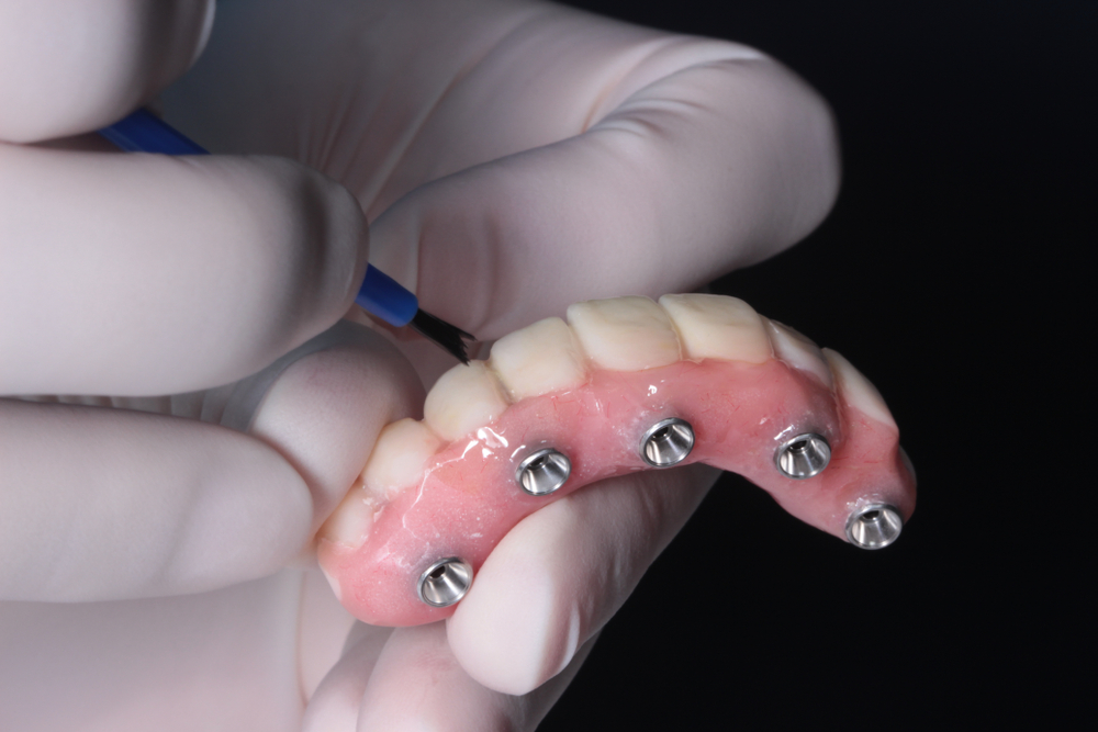 What You Should Know About All-on-4 Dental Implants