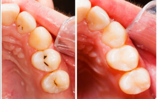 composite resin fillings keller