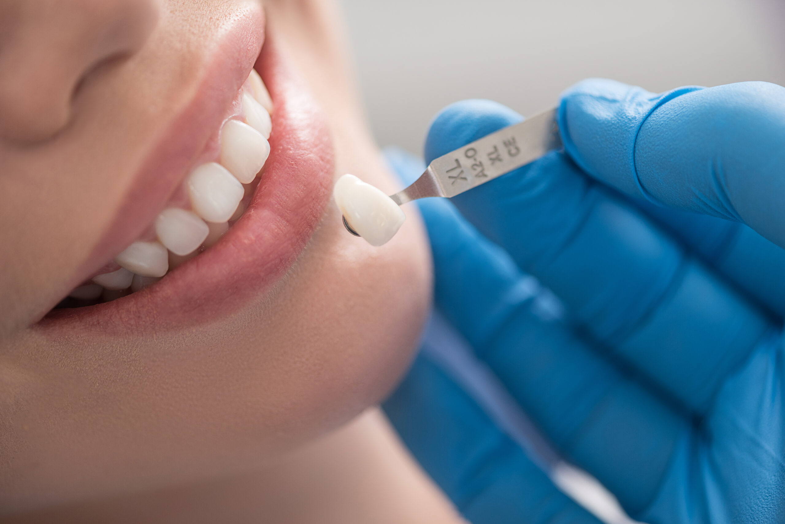 What To ﻿Do If Your Tooth Filling Falls Out