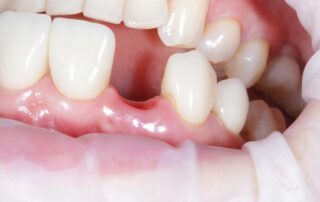 How We Clean and Heal Gum Tissue from Damaged and Missing Teeth
