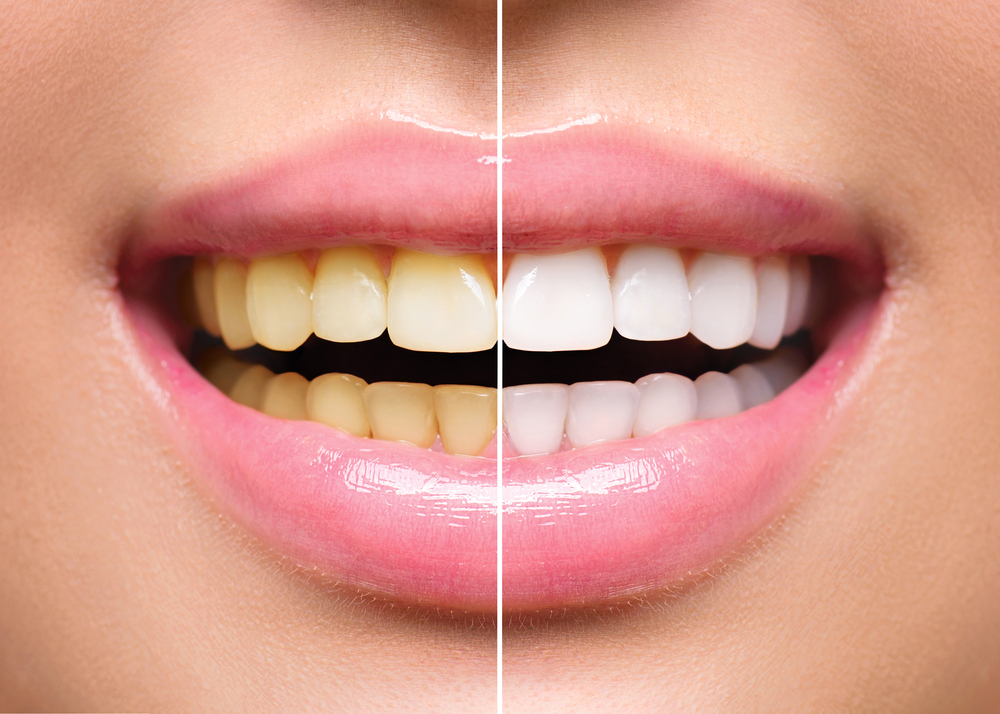 I Have Stained Yellow Teeth! What Can I Do? I Have Stained Yellow Teeth! What Can I Do?