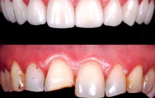 tooth reshaping
