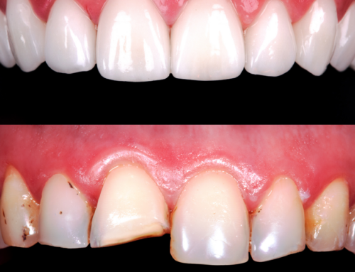 Tooth Reshaping
