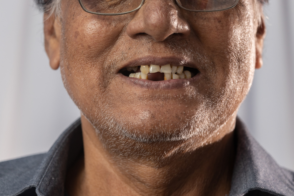 We Can Replace Multiple Teeth in a Single Visit We Can Replace Multiple Teeth in a Single Visit