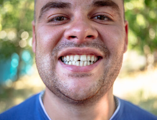 What to Know About Bonding: A Simple Fix for Chipped Teeth