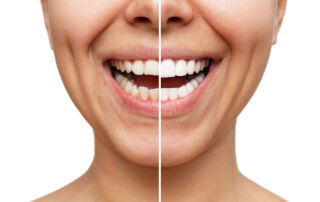 Do You Qualify for Dental Veneers Here’s How to Tell