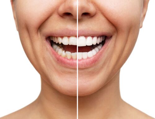 Do You Qualify for Dental Veneers? Here’s How to Tell
