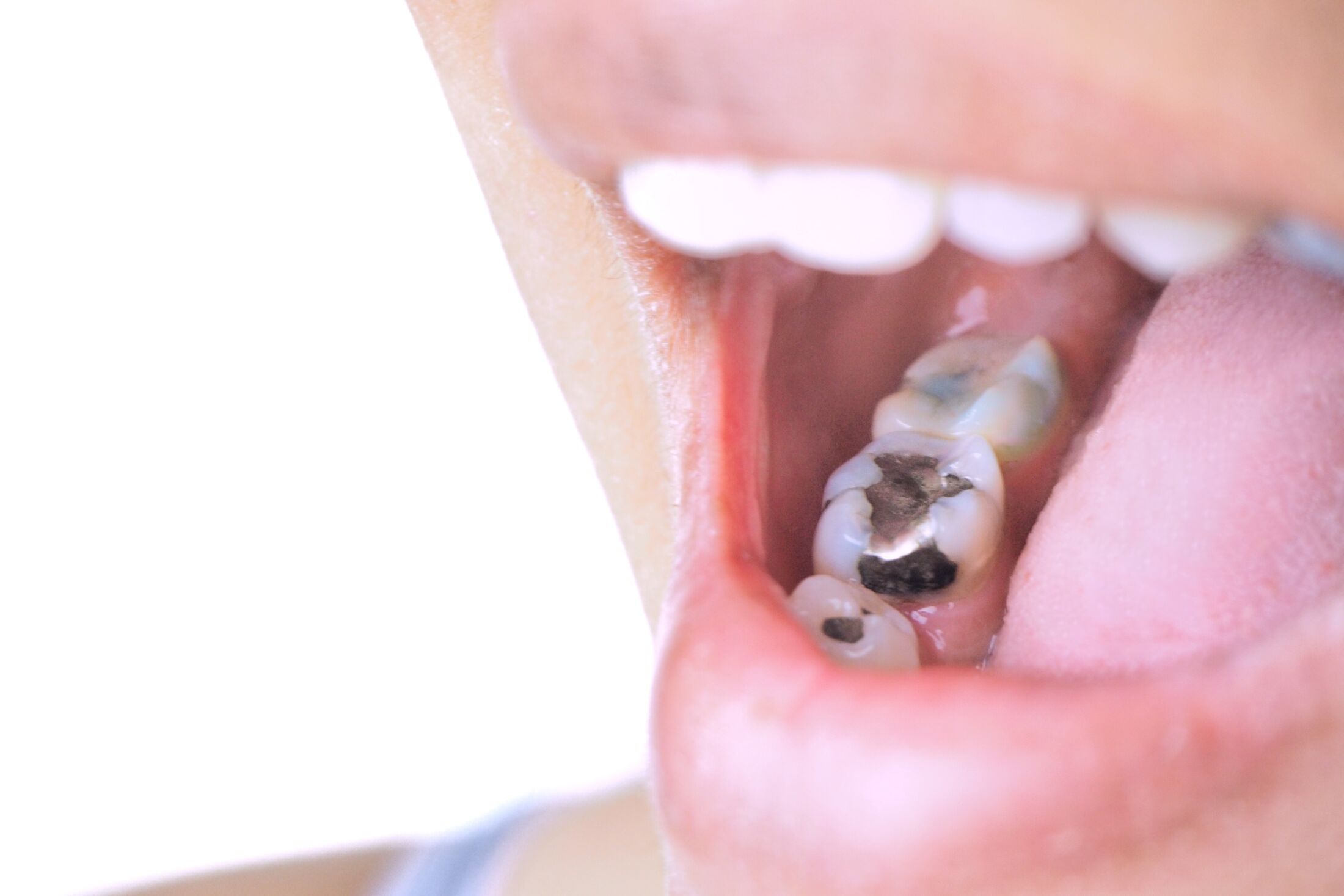 Signs It’s Time to Replace Old Fillings, Crowns, or Dentures