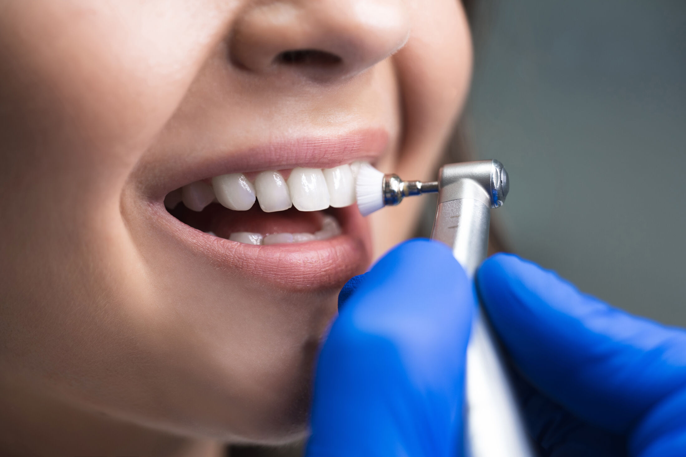 Why Dental Veneers Are So Popular Among Young Adults