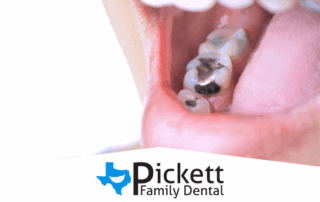 Signs It’s Time to Replace Old Fillings, Crowns, or Dentures