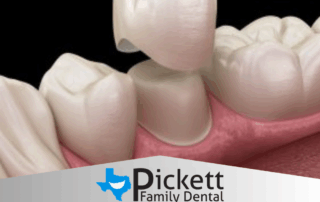 same day dental crowns keller