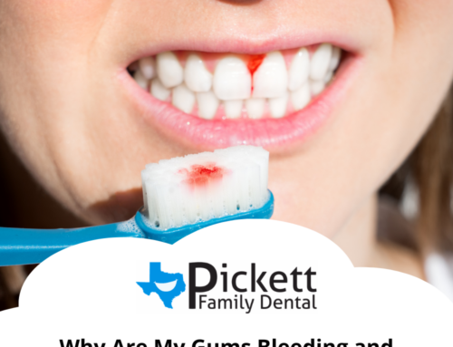 Why Are My Gums Bleeding and How Do I Stop It?