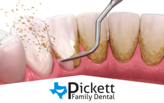 Dental Cleaning Near Me: Get a Dental Cleaning in Keller