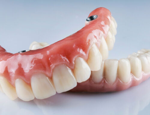 Dentures vs Implants: Which Is Better?